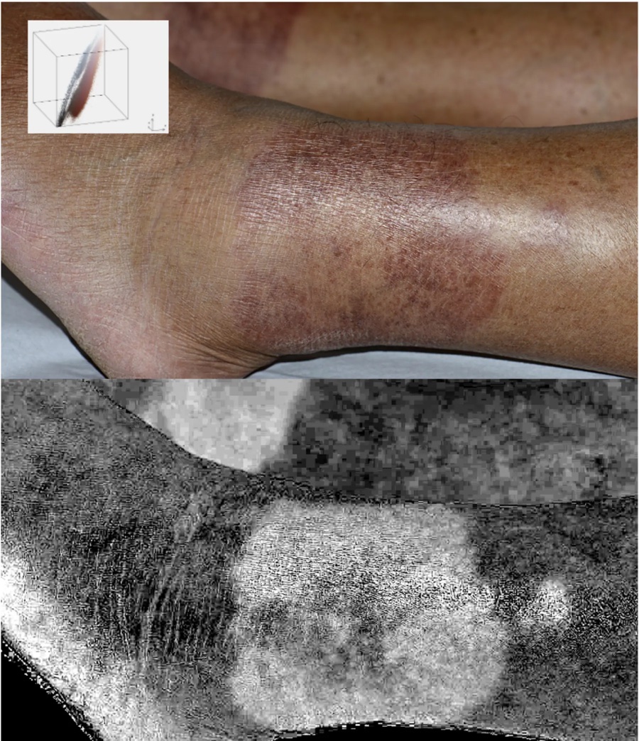 Clinical photo of erythema in pigmented skin beside its computed erythema map