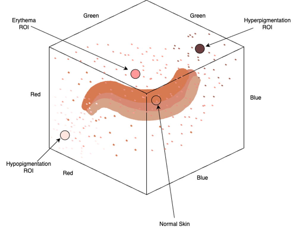 RGB color-space model separating erythema from pigmentation